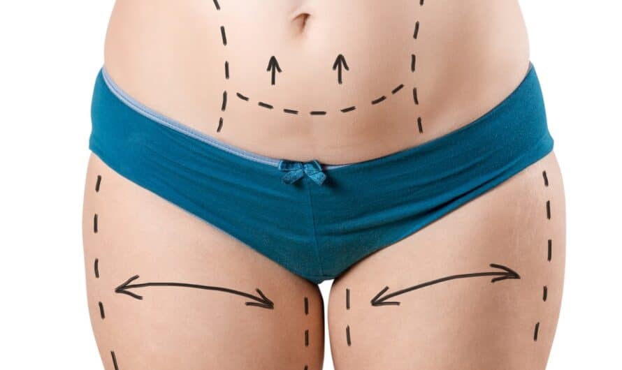 Quel poids pour faire une abdominoplastie?